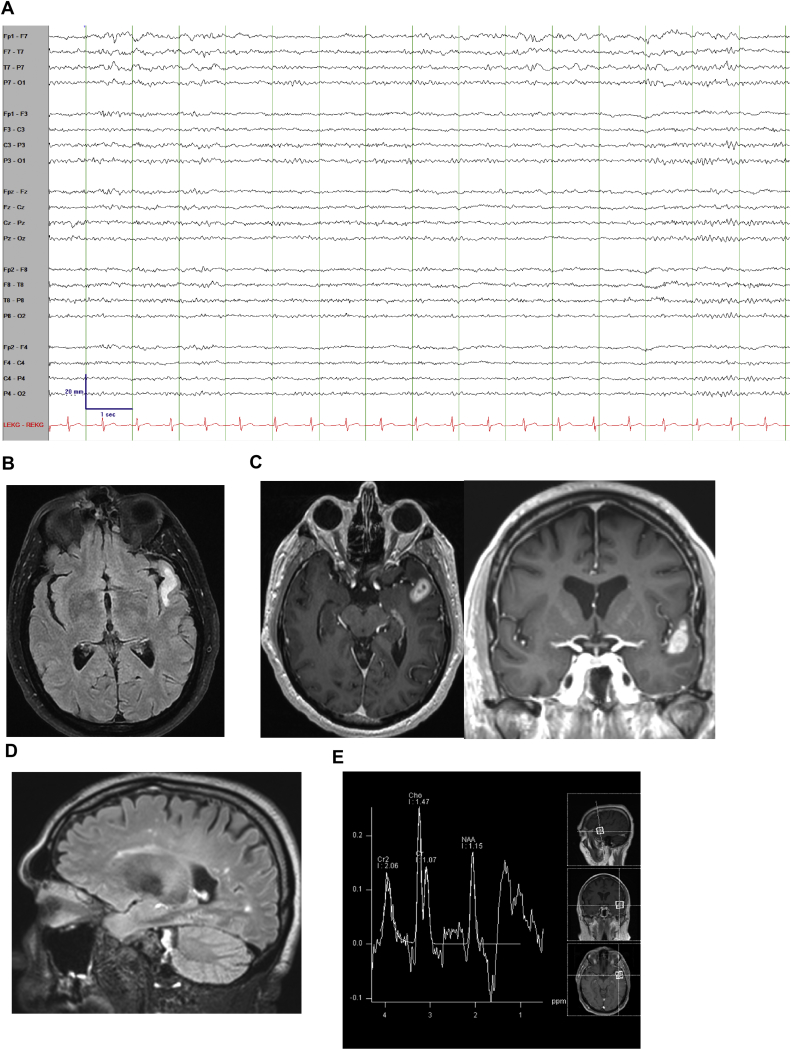 Paroxysmal dysphasia in a 68 year-old man: Enhancing the MRI spectrum!