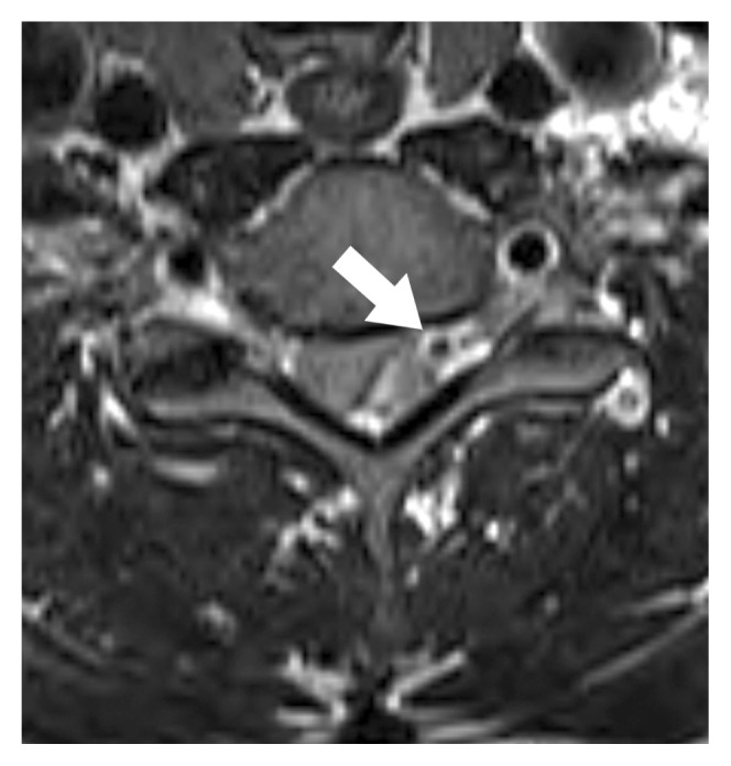 Spontaneous Epidural Hematoma Associated with Venous Phlebolith in Cervical Spine and Possible Pathogenesis.