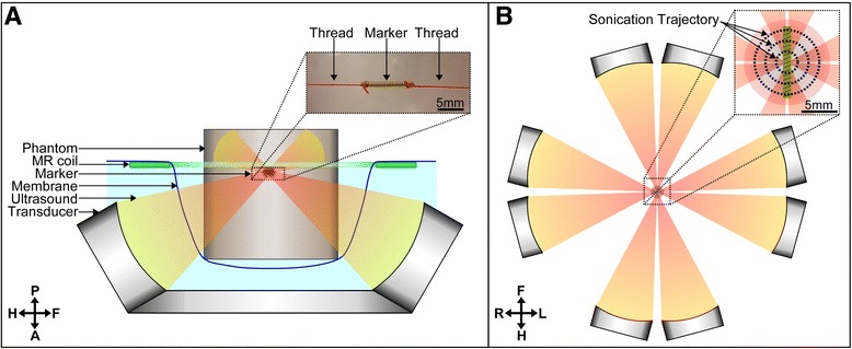 Magnetic Resonance-guided High Intensity Focused Ultrasound in the presence of biopsy markers.