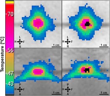 Magnetic Resonance-guided High Intensity Focused Ultrasound in the presence of biopsy markers.