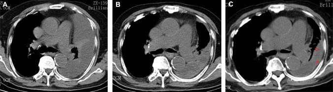 Dabigatran-Induced Massive Spontaneous Hemothorax.