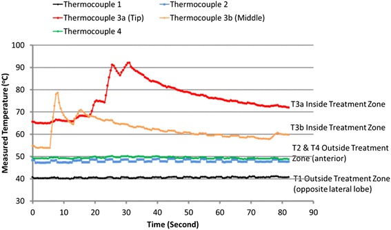 Clinical validation of real-time tissue change monitoring during prostate tissue ablation with high intensity focused ultrasound.