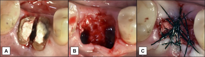 Extraction Socket Preservation Using Porcine-Derived Collagen Membrane Alone or Associated with Porcine-Derived Bone. Clinical Results of Randomized Controlled Study.