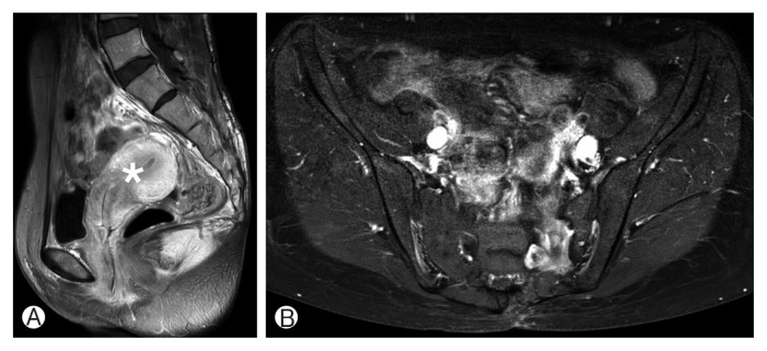 Single Stage Posterior Approach for Total Resection of Presacral Giant Schwannoma: A Technical Case Report.