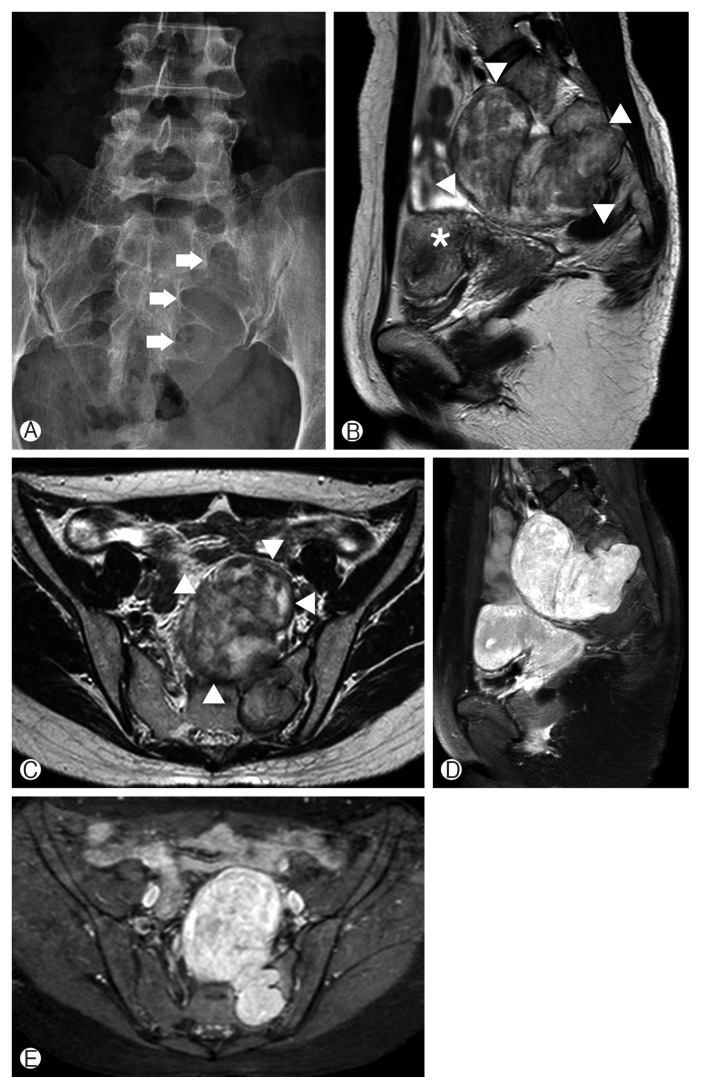 Single Stage Posterior Approach for Total Resection of Presacral Giant Schwannoma: A Technical Case Report.