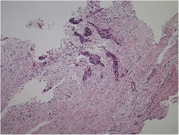 Desmoplastic small round cell tumors of the pleura: a review of the clinical literature.