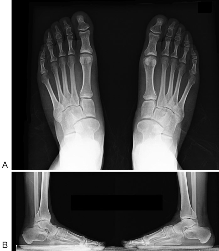 Talonavicular Coalition as a Cause of Foot Pain.