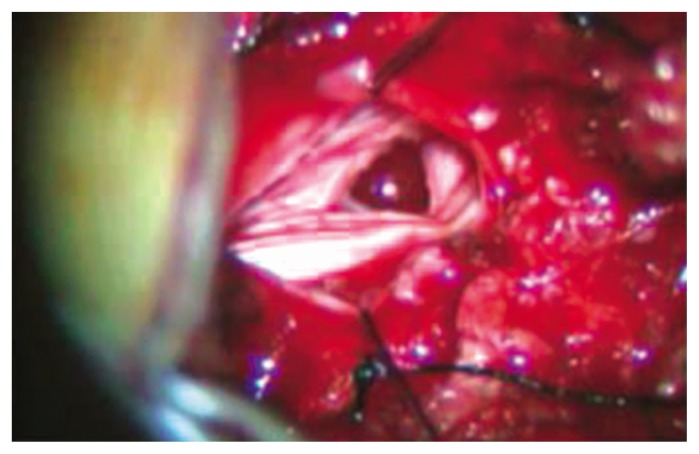 Incarceration of Spinal Nerve Root through Incidental Durotomy as a Cause of Sciatica.