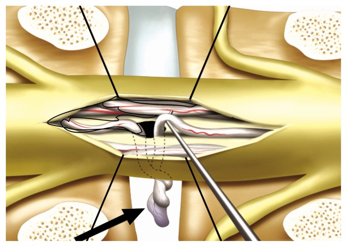 Incarceration of Spinal Nerve Root through Incidental Durotomy as a Cause of Sciatica.