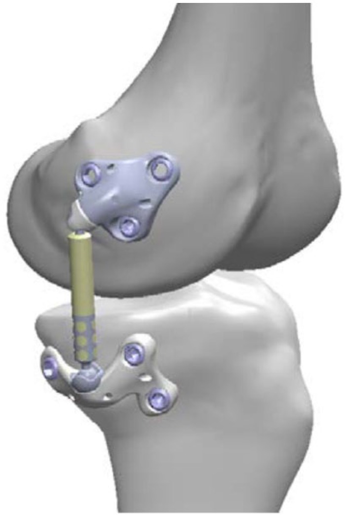 Feasibility of the Atlas Unicompartmental Knee System Load Absorber in Improving Pain Relief and Function in Patients Needing Unloading of the Medial Compartment of the Knee: 1-Year Follow-Up of a Prospective, Multicenter, Single-Arm Pilot Study (PHANTOM High Flex Trial).