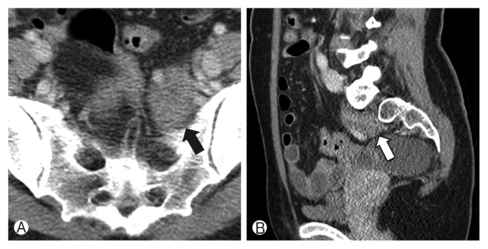 Ganglioneuroma of the Sacrum.