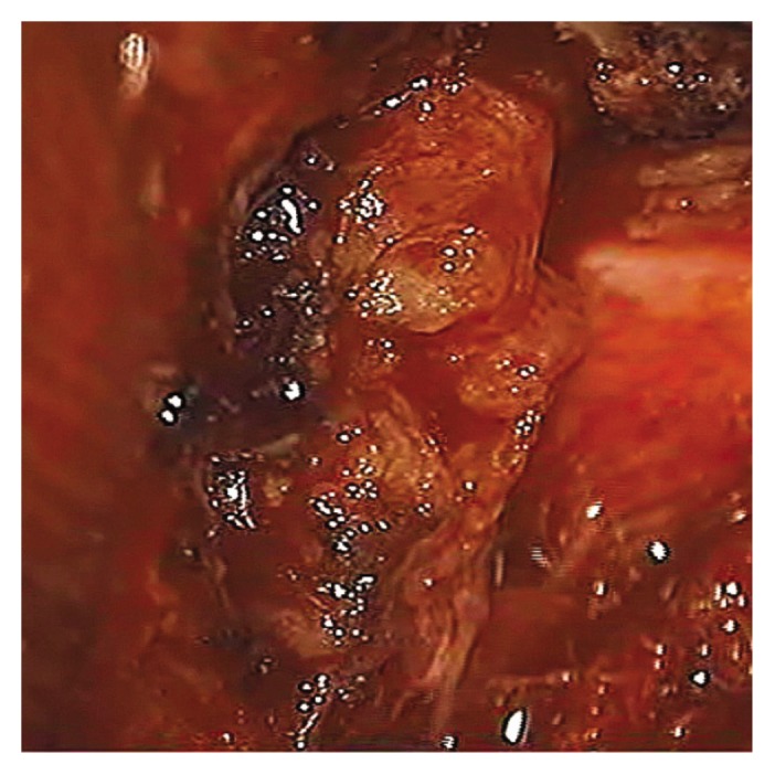 Ganglioneuroma of the Sacrum.