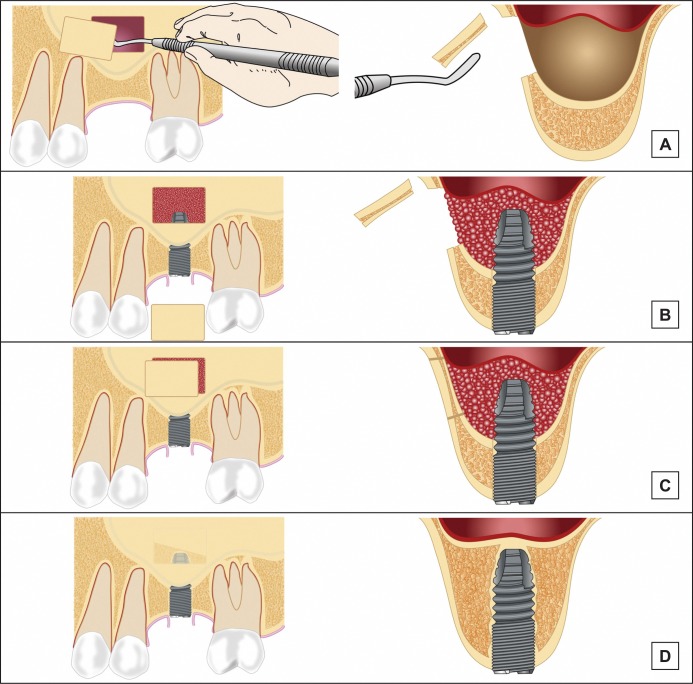 Maxillary Sinus Floor Augmentation: a Review of Selected Treatment Modalities.