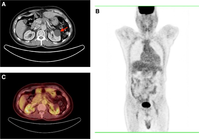 Incremental Role of Fluorine 18-Fluorodeoxyglucose Positron Emission Tomography/Computed Tomography in the Assessment of Computed Tomography-Inconspicuous Pancreatic Lesions.