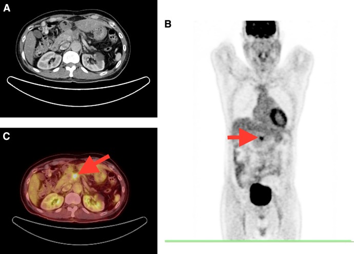 Incremental Role of Fluorine 18-Fluorodeoxyglucose Positron Emission Tomography/Computed Tomography in the Assessment of Computed Tomography-Inconspicuous Pancreatic Lesions.