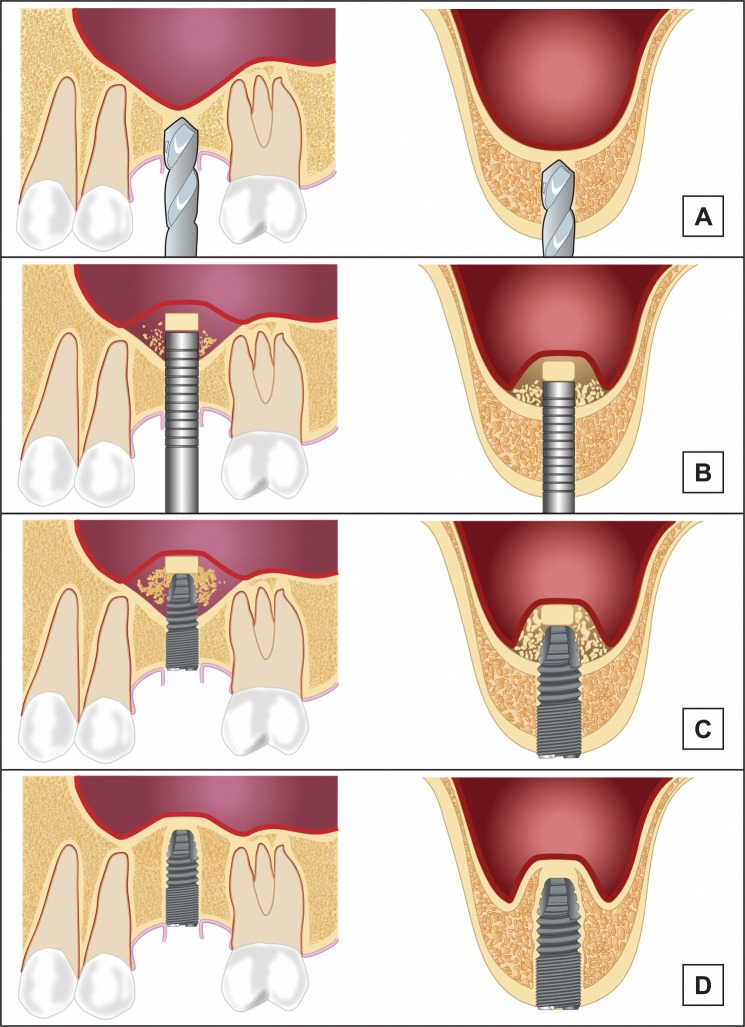Maxillary Sinus Floor Augmentation: a Review of Selected Treatment Modalities.