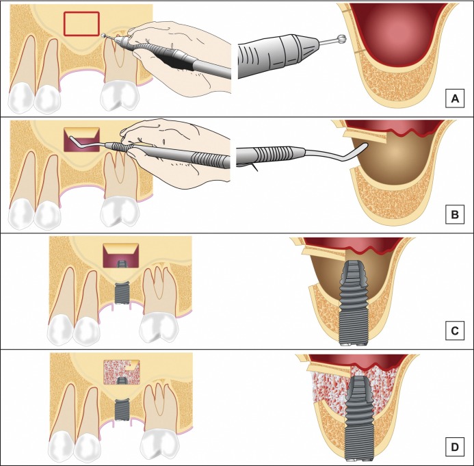 Maxillary Sinus Floor Augmentation: a Review of Selected Treatment Modalities.