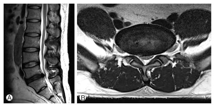 Posttraumatic Guillain-Barré Syndrome Immediately Following a Traffic Accident.