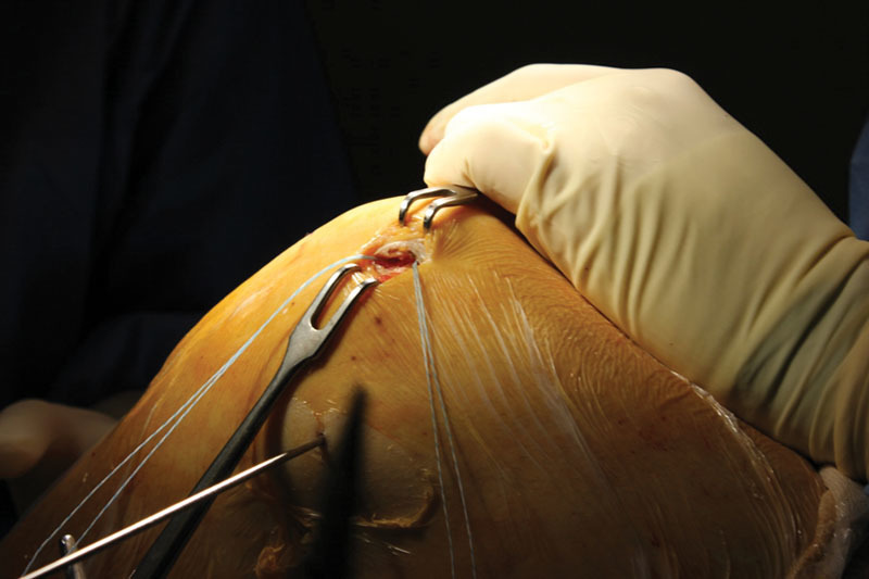 Suture Anchors Fixation in MPFL Reconstruction using a Bioactive Synthetic Ligament.