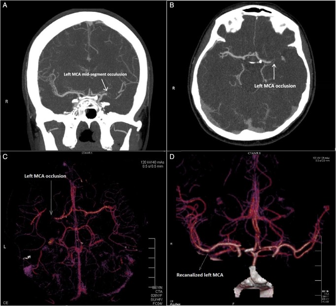 Management of an acute ischemic stroke during thrombolytic treatment in a pregnant patient with prosthetic valve thrombosis.