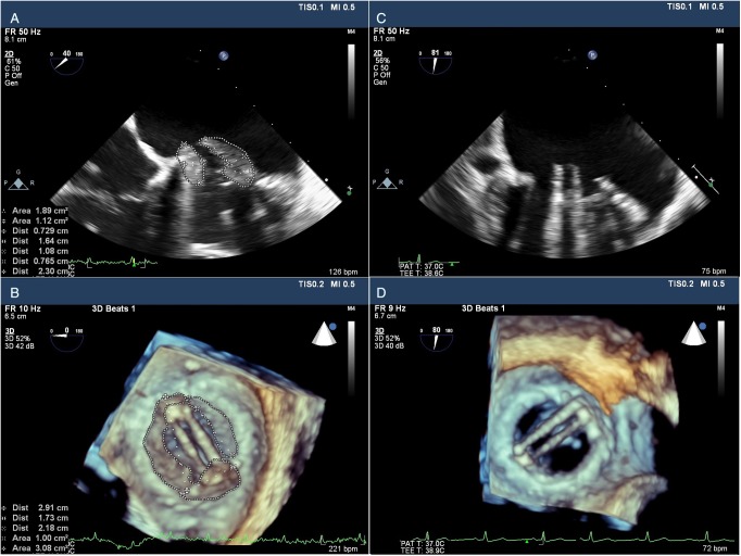 Management of an acute ischemic stroke during thrombolytic treatment in a pregnant patient with prosthetic valve thrombosis.