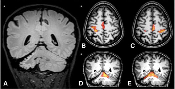 Hemicerebellitis can drive handedness shift.