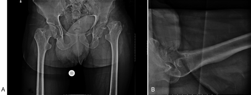 Total Hip Arthroplasty in an Inveterate Femoral Neck Fracture in a Patient with Congenital Insensitivity to Pain with Anhidrosis.