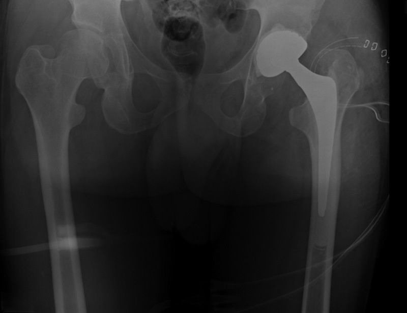 Total Hip Arthroplasty in an Inveterate Femoral Neck Fracture in a Patient with Congenital Insensitivity to Pain with Anhidrosis.