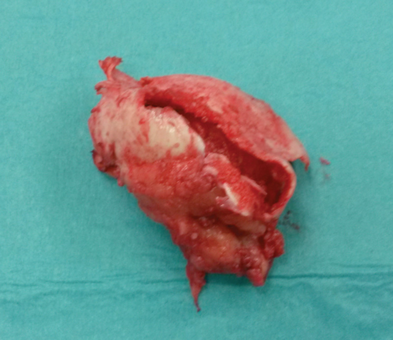 Total Hip Arthroplasty in an Inveterate Femoral Neck Fracture in a Patient with Congenital Insensitivity to Pain with Anhidrosis.