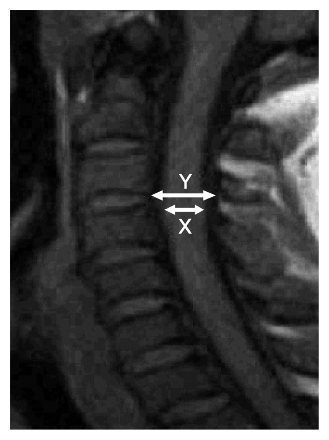 Space Available for the Cervical Spinal Cord of Asymptomatic Adult Nigerians.