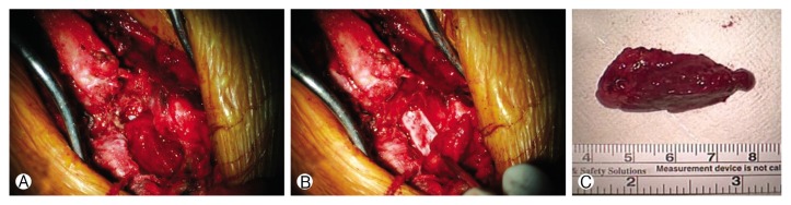 Angiolipoma on the Lumbar Spine.