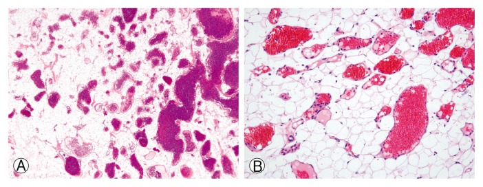 Angiolipoma on the Lumbar Spine.