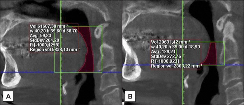 Pharyngeal Airway Dimensions and Head Posture in Obstructive Sleep Apnea Patients with and without Morphological Deviations in the Upper Cervical Spine.