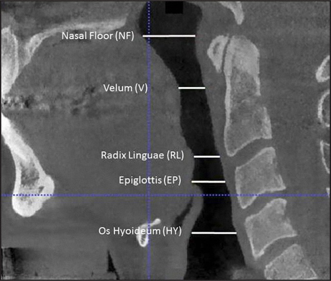 Pharyngeal Airway Dimensions and Head Posture in Obstructive Sleep Apnea Patients with and without Morphological Deviations in the Upper Cervical Spine.