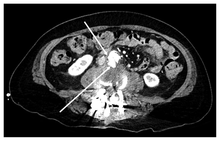 Aortic Injury during Transforaminal Lumbar Interbody Fusion.