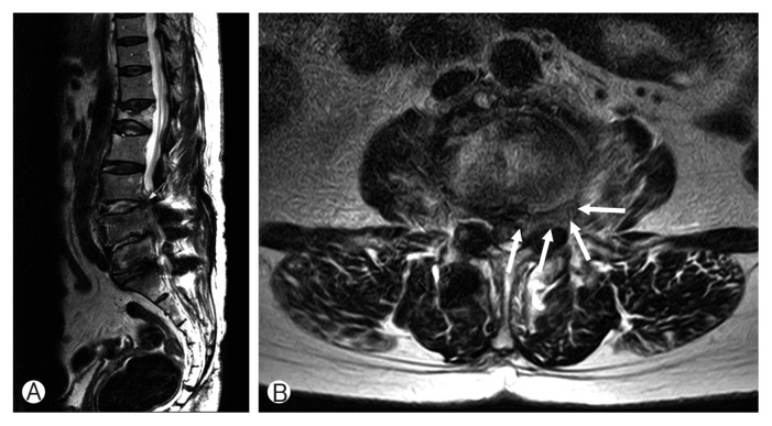 Aortic Injury during Transforaminal Lumbar Interbody Fusion.