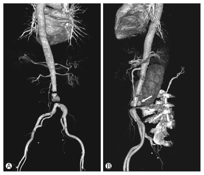 Aortic Injury during Transforaminal Lumbar Interbody Fusion.