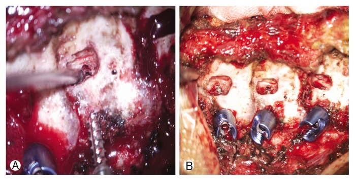 Cervical Pedicle Screw Placement Using Medial Funnel Technique.