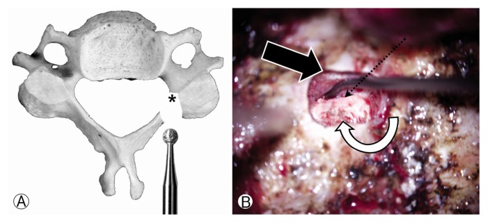 Cervical Pedicle Screw Placement Using Medial Funnel Technique.