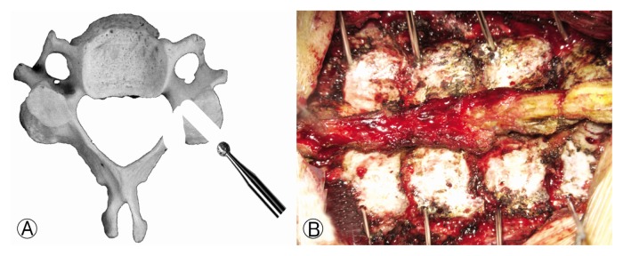 Cervical Pedicle Screw Placement Using Medial Funnel Technique.