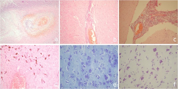 Pathomorphological peculiarities of tuberculous meningoencephalitis associated with HIV infection.