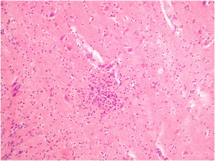 Pathomorphological peculiarities of tuberculous meningoencephalitis associated with HIV infection.