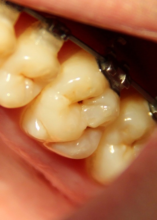 Sex differences of odontometrical indexes crowns of molars.