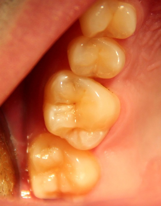 Sex differences of odontometrical indexes crowns of molars.