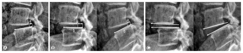 Long-term Clinical and Radiological Outcomes after Central Decompressive Laminoplasty for Lumbar Spinal Stenosis.