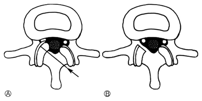 Long-term Clinical and Radiological Outcomes after Central Decompressive Laminoplasty for Lumbar Spinal Stenosis.