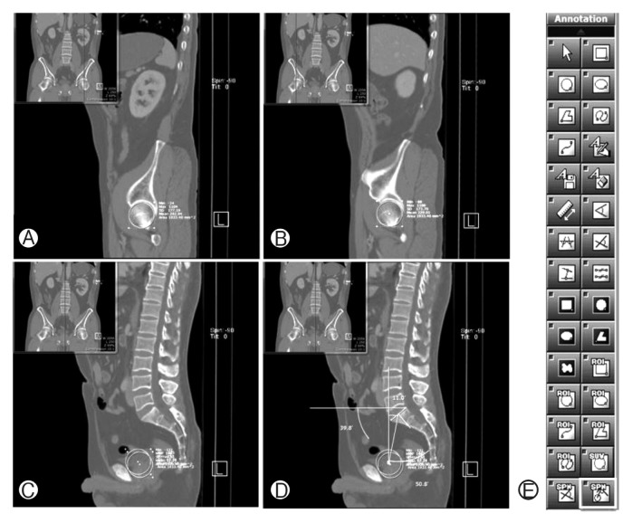 Pelvic Incidence Can Be Changed not only by Age and Sex, but also by Posture Used during Imaging.