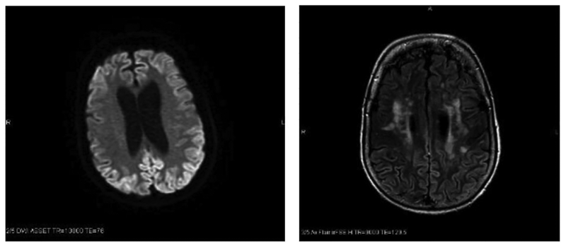 What Promises the CJD Diagnosis in a Case of Rapidly Progressive Dementia?