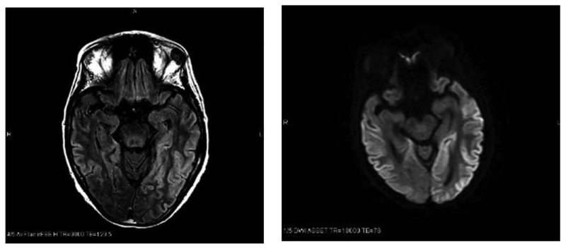 What Promises the CJD Diagnosis in a Case of Rapidly Progressive Dementia?