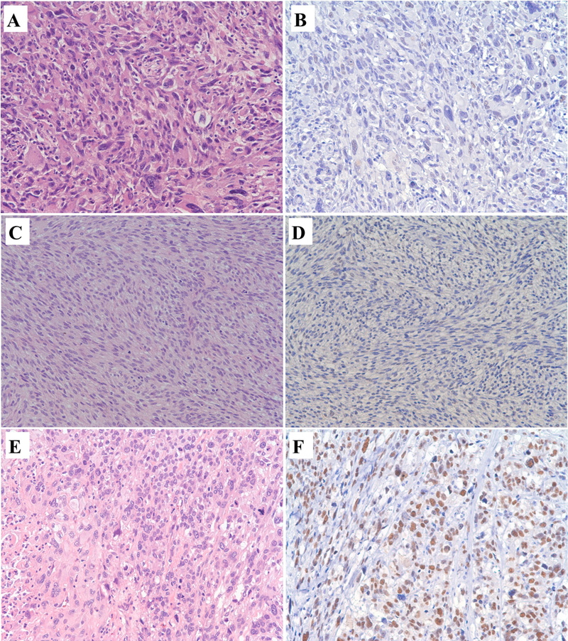 Loss of Expression of a Novel Chromatin Remodeler SMARCA1 in Soft Tissue Sarcoma.